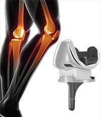 Artroplasti Knee System