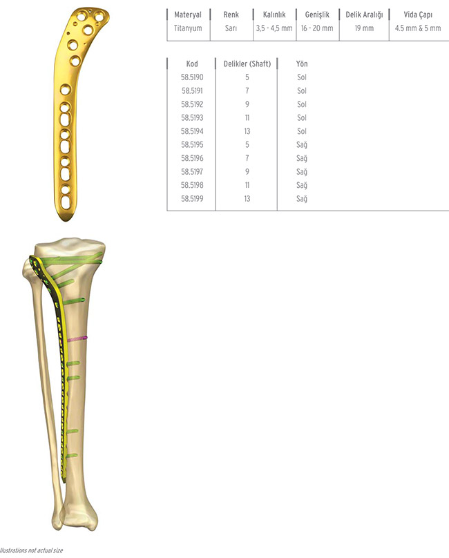 Unilock Tibia Proximal Lateral Plate