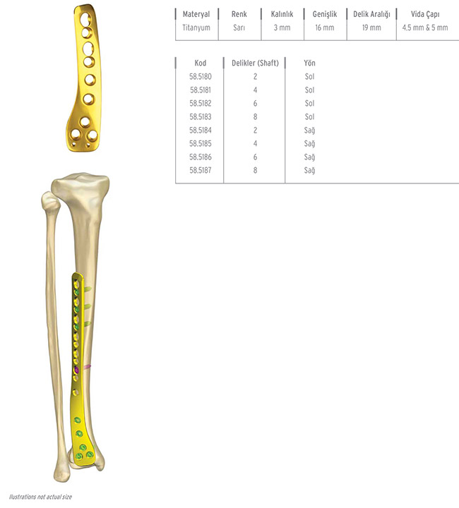 Unilock Tibia Distal Lateral Plate
