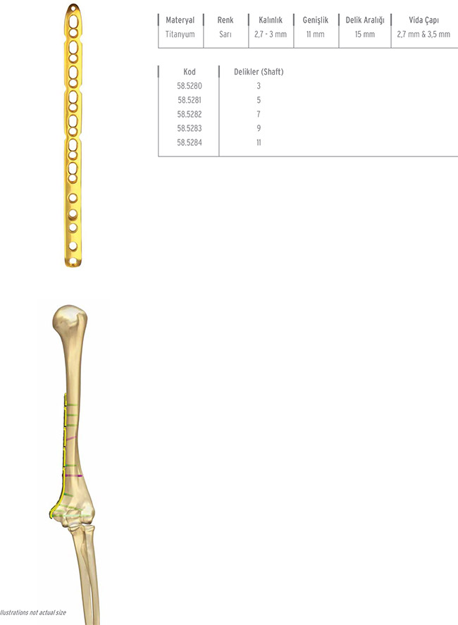 Unilock Humerus Distal Medial Plate