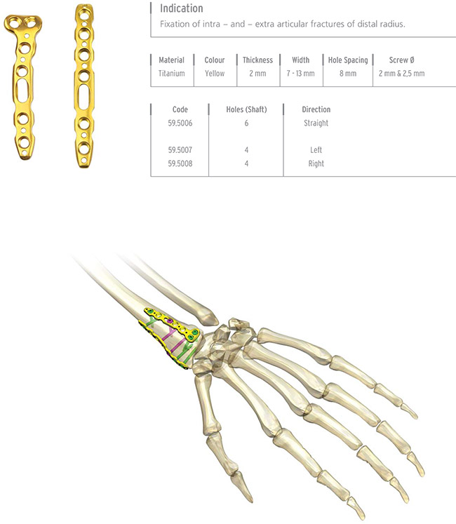 Unilock Radius Dorsal Plate